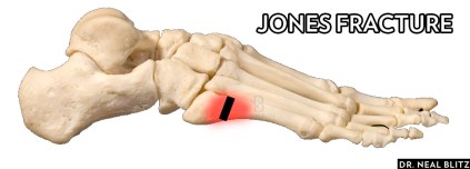 jonesfracture